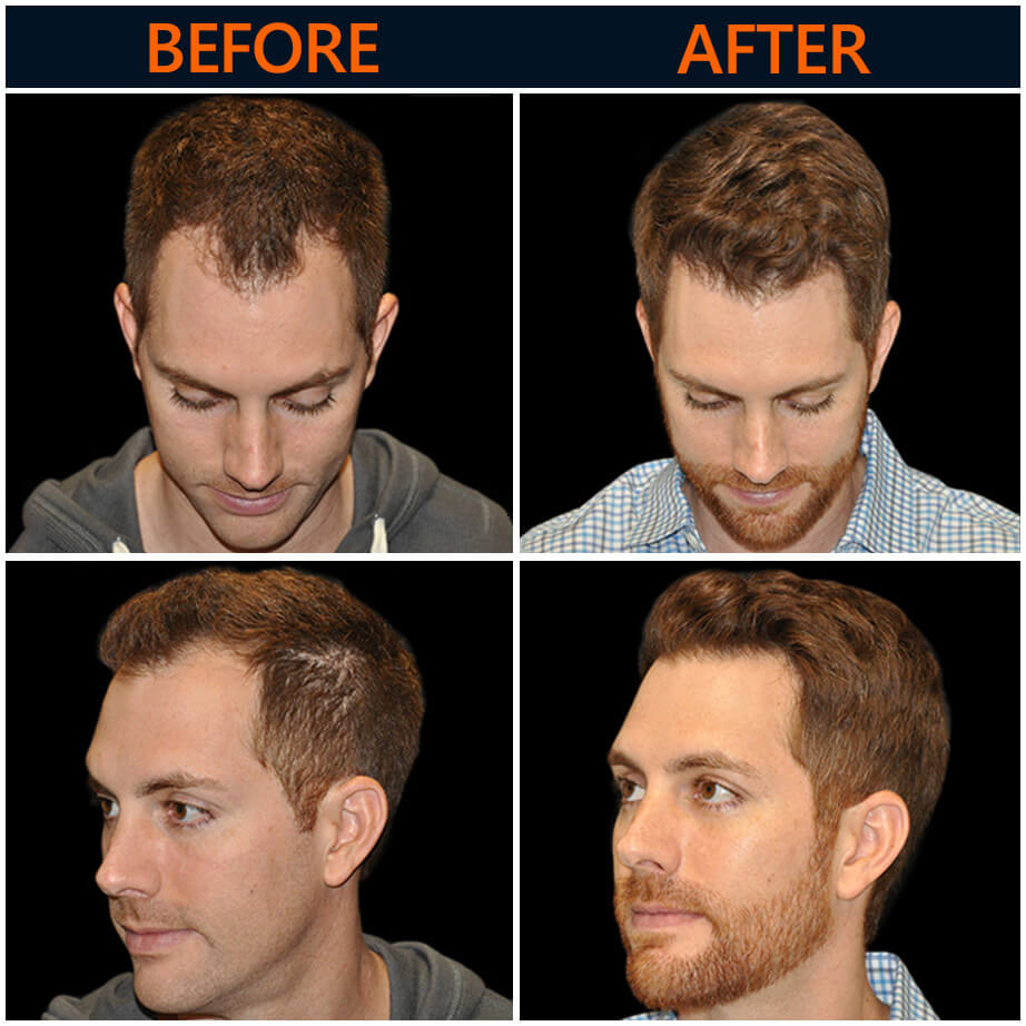Neograft Results