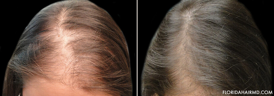 Stem Cell Hair Restoration Treatment Before And After