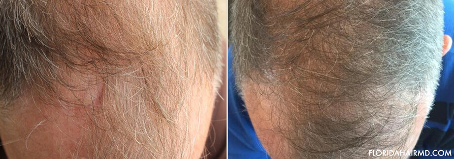 https://www.tampahairmd.com/images/Bassin-Hair-Restoration-Before-and-After-Case16.jpg