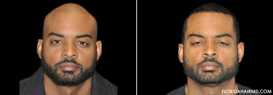 Hair Restoration Treatment Before And After