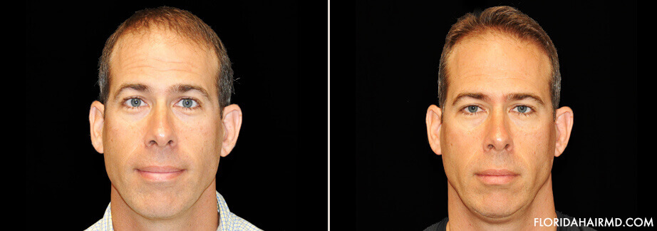 Hair Restoration Treatment Before & After