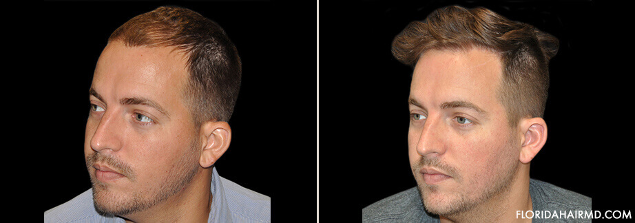 Hair Restoration Treatment Before & After