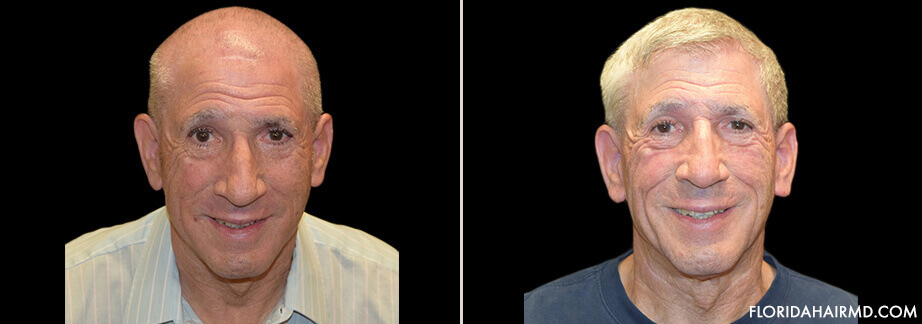 Before & After Hair Restoration