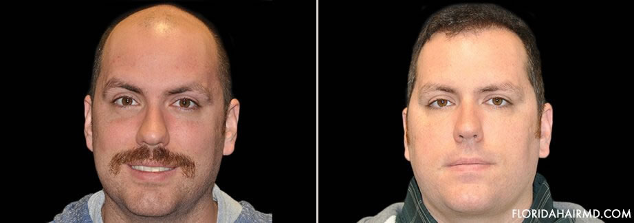 Hair Restoration Treatment Before And After