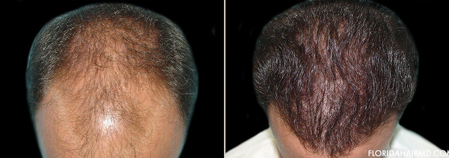 Hair Restoration Before & After