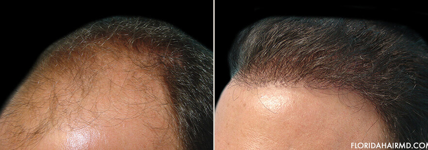 Hair Restoration Before And After