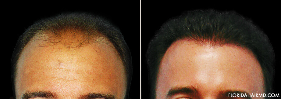 Hair Restoration Results